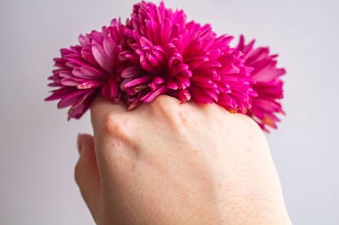 Parlak pembe kasımpatı tomurcuklarıyla cilt kızarıklığı olan bir el. 