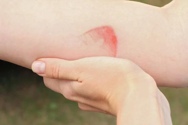 Hot iron burn on hand skin — Stock Photo, Image