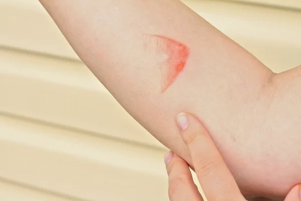 Hot iron burn on hand skin — Stock Photo, Image