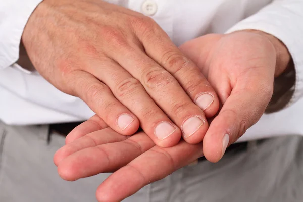 Mãos masculinas com pele seca. Dermatologia, conceito de cuidados com a pele tempo frio — Fotografia de Stock