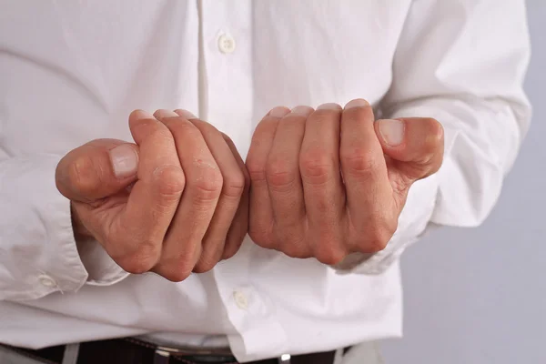 Mandlige hænder med tør hud. Dermatologi, koldt vejr hudpleje koncept - Stock-foto