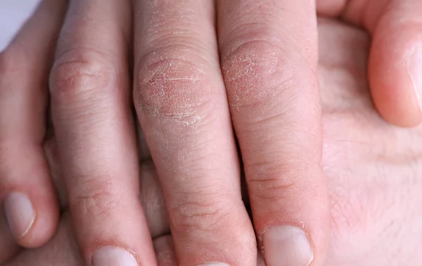 Manos Masculinas Secas Agrietadas Agrietadas Cerca Concepto Cuidado Piel Invierno — Foto de Stock