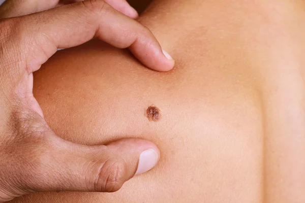 Doctor , Dermatologist, hands examines a birthmark of patient. Checking benign moles — Stok fotoğraf