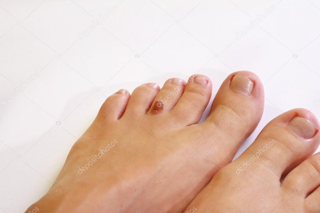 Female leg fingers with bithmark, beautiful female feet Stock Photo by