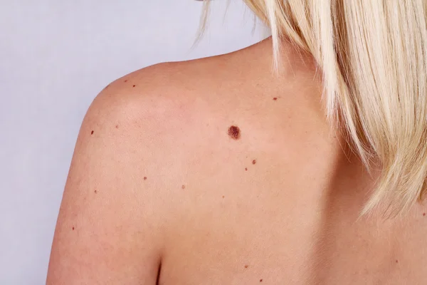 Young woman with at birthmark on her back, skin. Checking benign moles — Stock Photo, Image