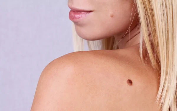 Young woman with birthmark on her face, back, skin. Checking benign moles — Stock Photo, Image