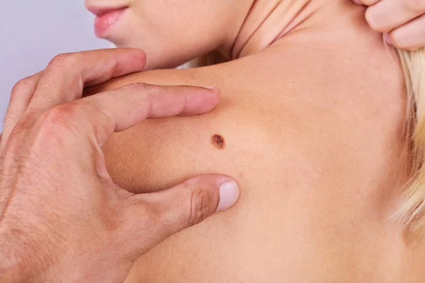 Dottore, dermatologo, le mani esaminano una voglia di paziente. Controllo delle talpe benigne — Foto Stock