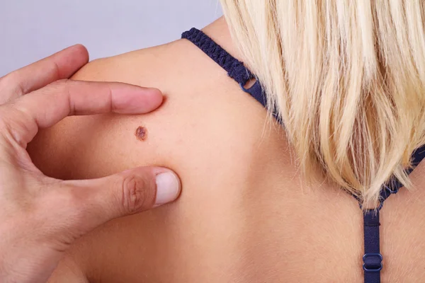 Dottore, dermatologo, le mani esaminano una voglia di paziente. Controllo delle talpe benigne — Foto Stock