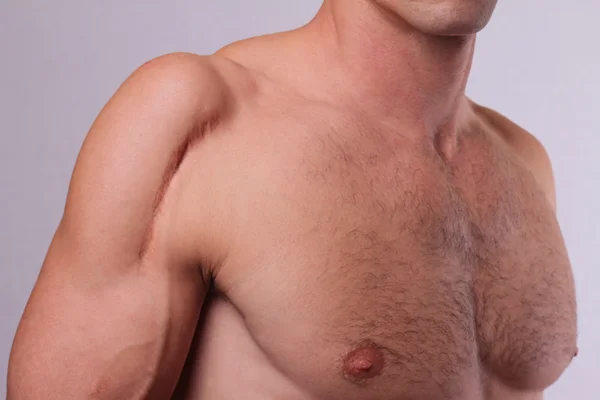 Чоловік з шрамом на плечі. Концепція лазерного зменшення шрамів — стокове фото