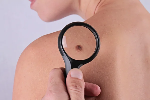 Doktorun yakın dermatolog inceliyor hasta bir doğum izine benzer. İyi huylu benler kontrol