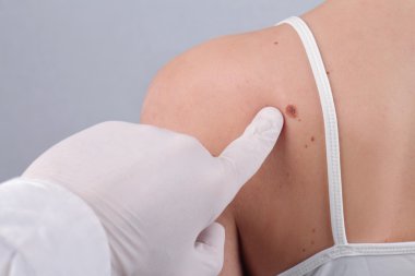 Doctor dermatologist examines  birthmark of patient close up. Checking benign moles