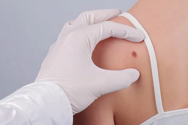 Doctor dermatologist examines  birthmark of patient close up. Checking benign moles