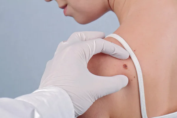 Doctor dermatologist examines  birthmark of patient close up. Checking benign moles — Stockfoto