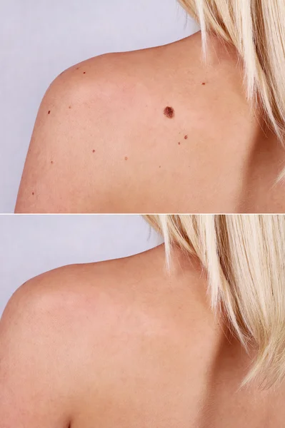 Laser treatment for birthmark removal before and after. — Stock Photo, Image