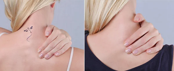 Laser tattoo removal before and after. Beautiful young woman with tattoo on her back