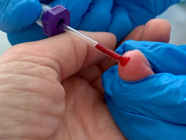 分析のために指から血を取るプロセス 毛細血管血 — ストック写真