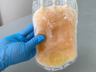 hand of a doctor or nurse holding a bag of fresh frozen blood storage plasma in a blood bank laboratory. Life saving concept.