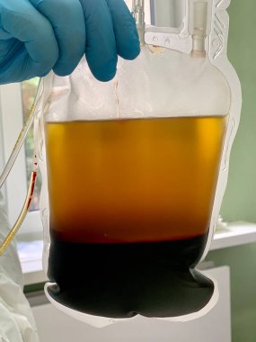 Kan, santrifüj yoluyla plazma ve eritrositlere ayrılır..