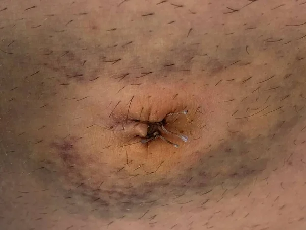 Bekas Luka Laparoskopi Pembedahan Bagian Perut Stitches Setelah Penghapusan Hernia — Stok Foto