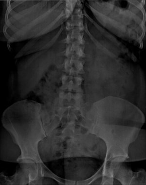 Piercing ile Rx karın