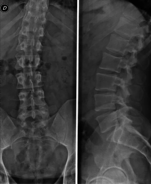 Lumbar spine x-ray — Stock Image Lumbar spine x-ray Stock Picture