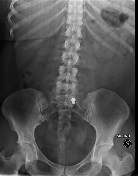 Rx abdomen with piercing — Stock Image Rx abdomen with piercing Royalty Free Stock Images
