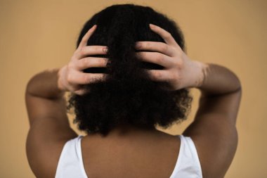 Vitiligo hastalığı olan bir kadın ellerini kafasında tutuyor.