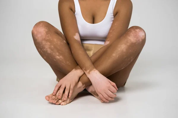 Vitiligo skin woman sitting legs crossed at the studio