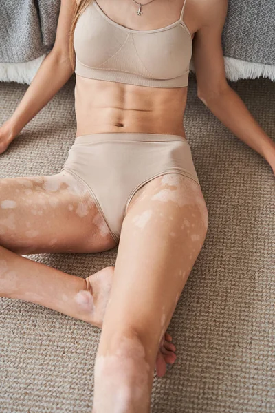 Feminino com vitiligo afetado pele posando em seu quarto em lingerie bege, enquanto estabelece — Fotografia de Stock