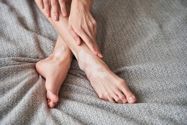 Pernas de vitiligo afetado jovem deitado na cama em seu apartamento acolhedor — Fotografia de Stock