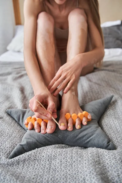 Vrouw met vitiligo doen pedicure met houten stok na het aanbrengen van lak — Stockfoto