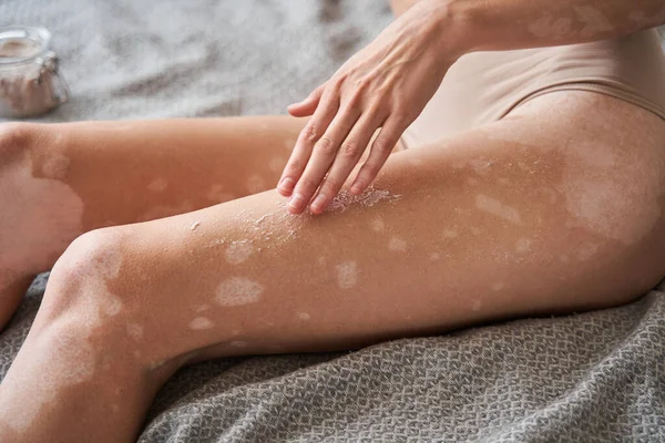 Mulher com pele vitiligo sentado na cama e aplicando hidratante em suas pernas — Fotografia de Stock