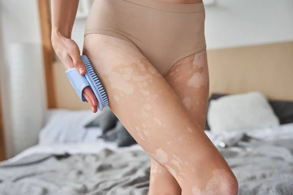Woman with vitiligo disorder holding dry brush and massaging her hips