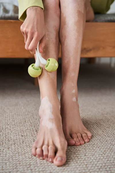 Mulher com vitiligo fazendo massagem pernas com rolos de jade verde para spa — Fotografia de Stock
