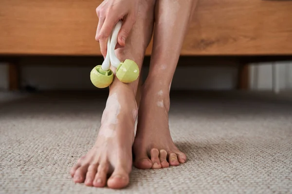 Mulher com vitiligo fazendo massagem pernas com rolos de jade verde para cuidados com a pele spa — Fotografia de Stock