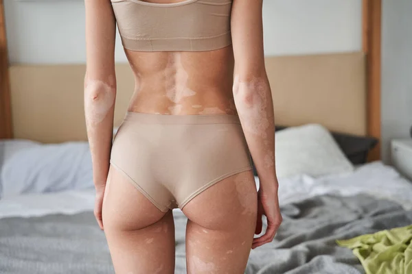 Vrouw dragen beige lingerie tonen witte vitiligo vlekken terwijl poseren op haar flat — Stockfoto