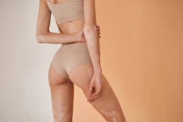 Vrouw in ondergoed, tonen witte vitiligo vlekken op haar rug en armen — Stockfoto