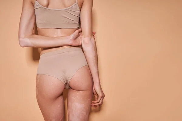 Mädchen mit Vitiligo-Störung zeigt ihren Rücken, während sie im Studio posiert — Stockfoto