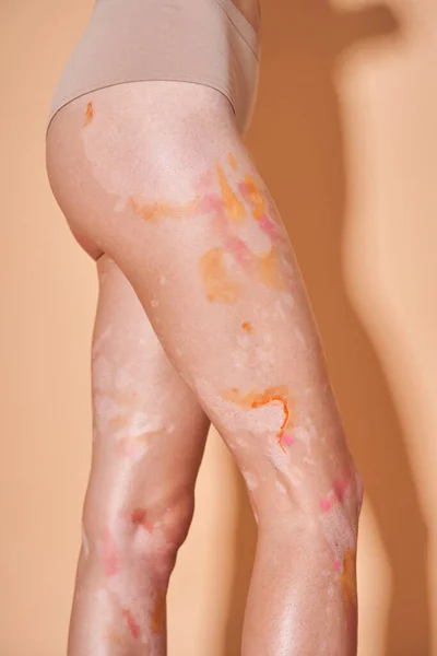 Woman with vitiligo skin posing at the studio near the beige wall
