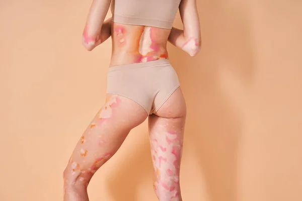 Meisje met vitiligo huid dragen beige lingerie poseren in de studio in de buurt van de lichtmuur — Stockfoto