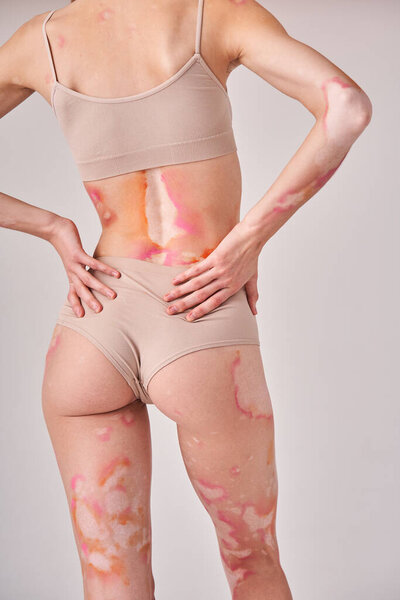 Женщина с расстройством витилиго стоит в бежевых трусиках и бинтах над грудью
