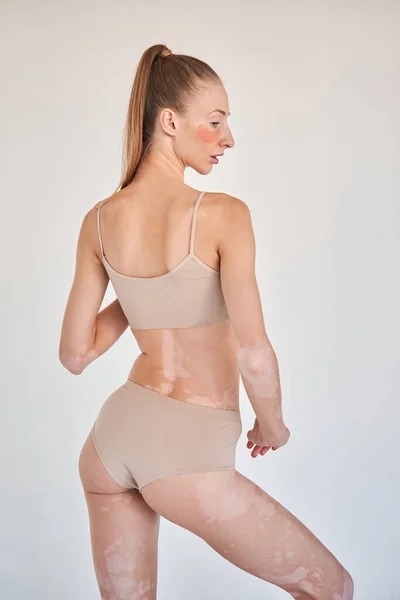 Woman with vitiligo skin and under eye mask posing at the underwear at the studio