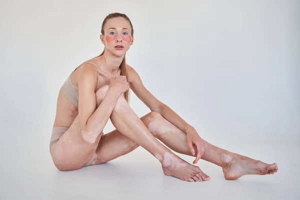 Mujer con enfermedad del vitiligo sentada delante si la pared blanca y mirando a la cámara — Foto de Stock