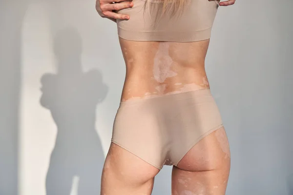 Kobieta z chorobą biegunkową dba o swoją skórę stojąc w studio — Zdjęcie stockowe