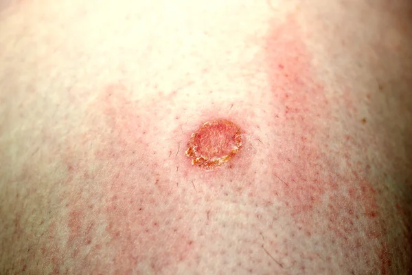 Herida en la piel produce dolor — Foto de Stock