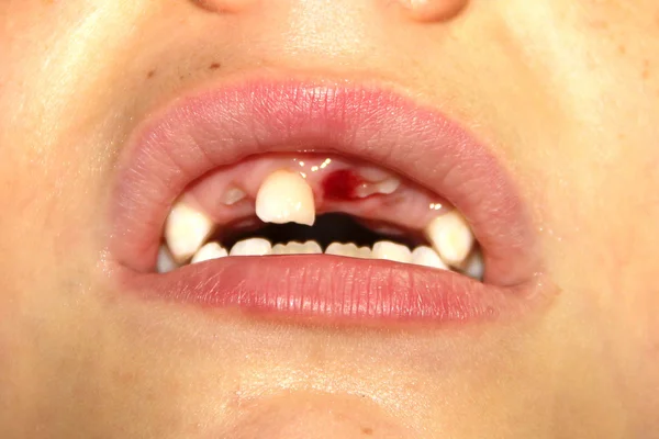 Süt dişleri sadece düşmüş ve yeni görünmesini