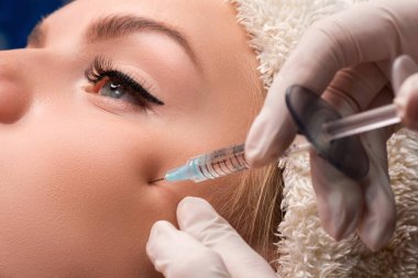 Güzellik uzmanı elmacık kemiklerine hiyalüronik asit enjekte ediyor. Deri gençleştirme enjeksiyonları.