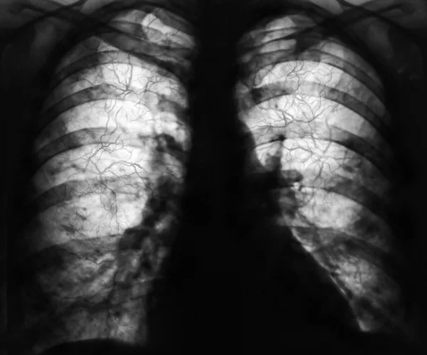 Xray of the lungs — Stock Photo, Image