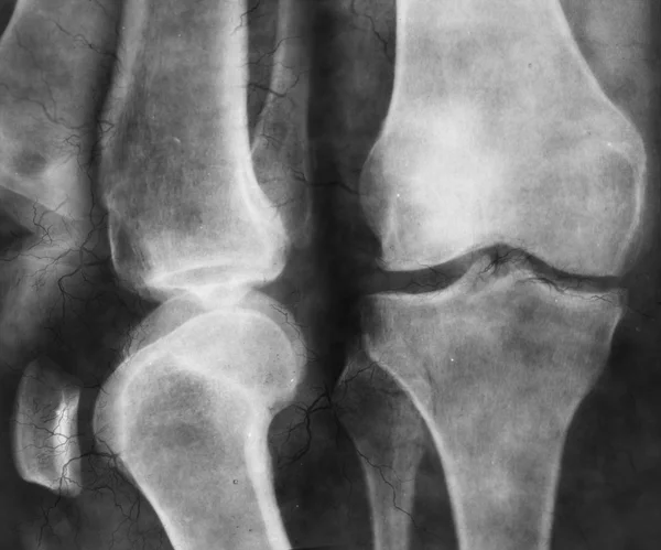Xray dizde