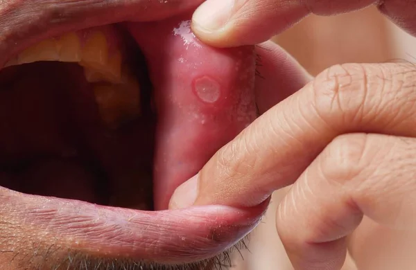 Mouth Ulcers Other Causes Orofacial Soreness Pain — Stock Photo, Image